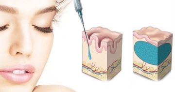 Filler Acido ialuronico