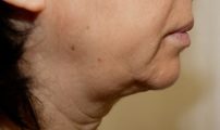 Lassità cutanea 3_prima