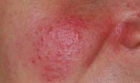 acne rosacea_prima