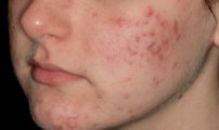 acne_prima