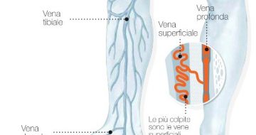 Insufficienza venosa e vene varicose: non prendiamoli sotto gamba